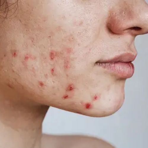 Close up of a woman’s face showing acne on her cheek and jawline, indicating skin health issues.